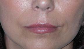 Lip Augmentation - Patient 4 - After